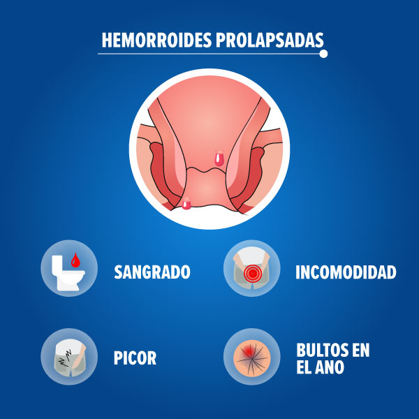 Causas de las hemorroides infografia